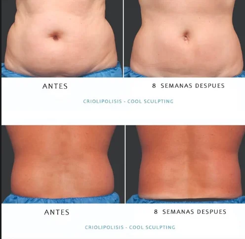 Resultado Criolipólisis · Cool Sculpting - Estética Silvia Flamini