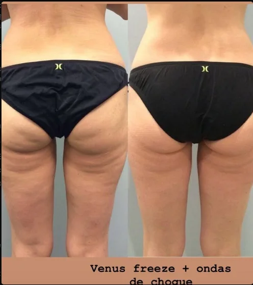 Resultado Venus Freeze + ondas de choque - Estética Silvia Flamini
